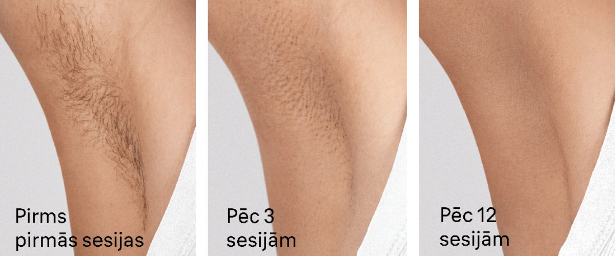 Fotoepilatora rezultāti pirms un pēc lietošanas